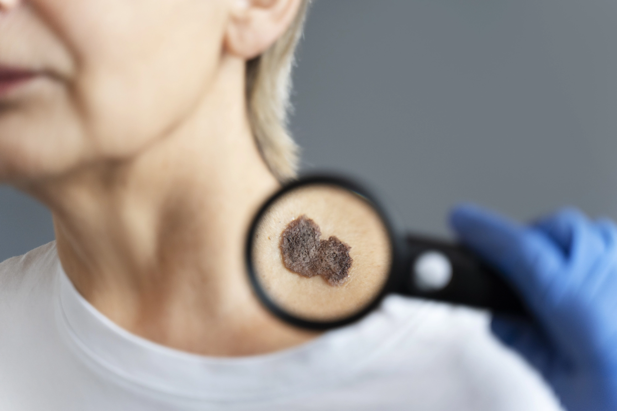 Evaluación dermatológica de tumores benignos