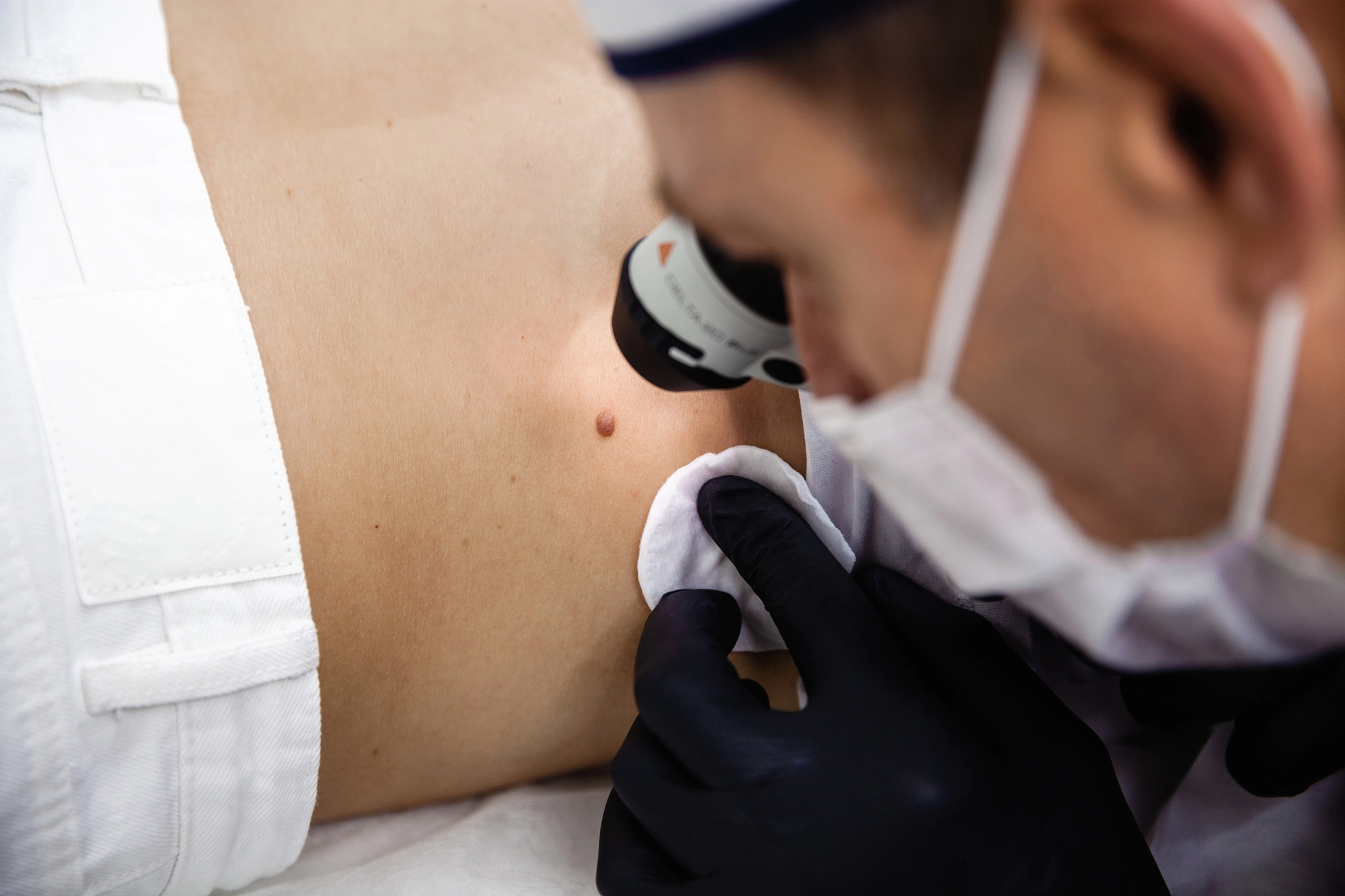 Examen dermatológico previo a electrofulguración
