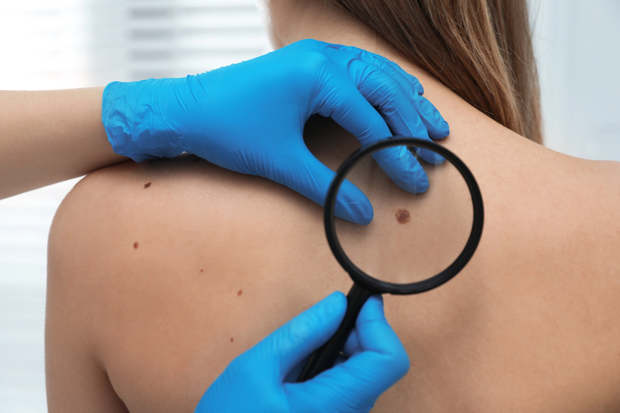 Especialista realizando crioterapia dermatológica