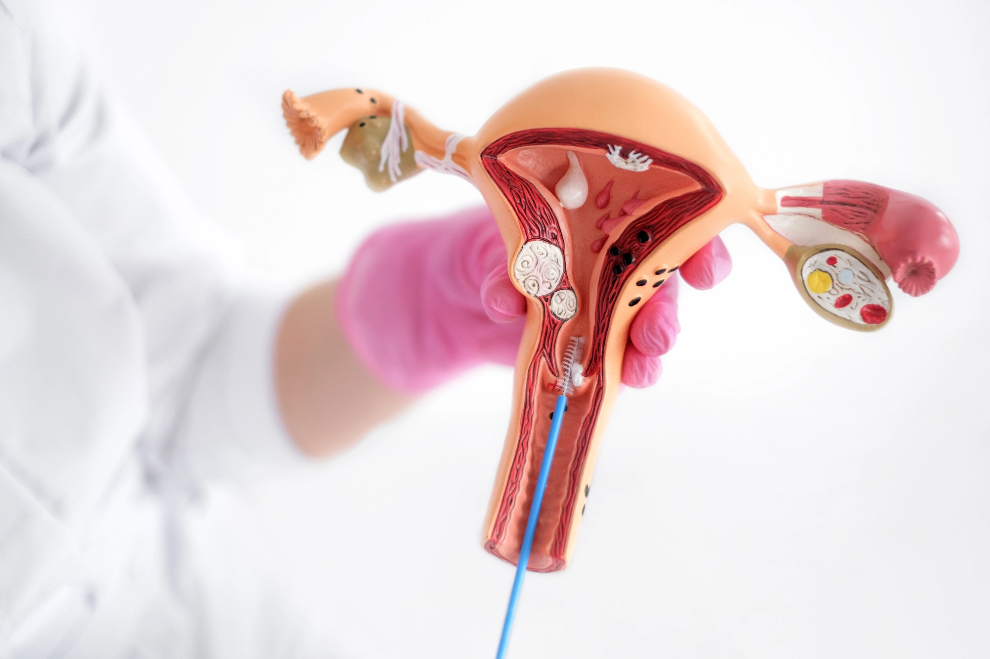 Especialista explicando toma de biopsia de endometrio