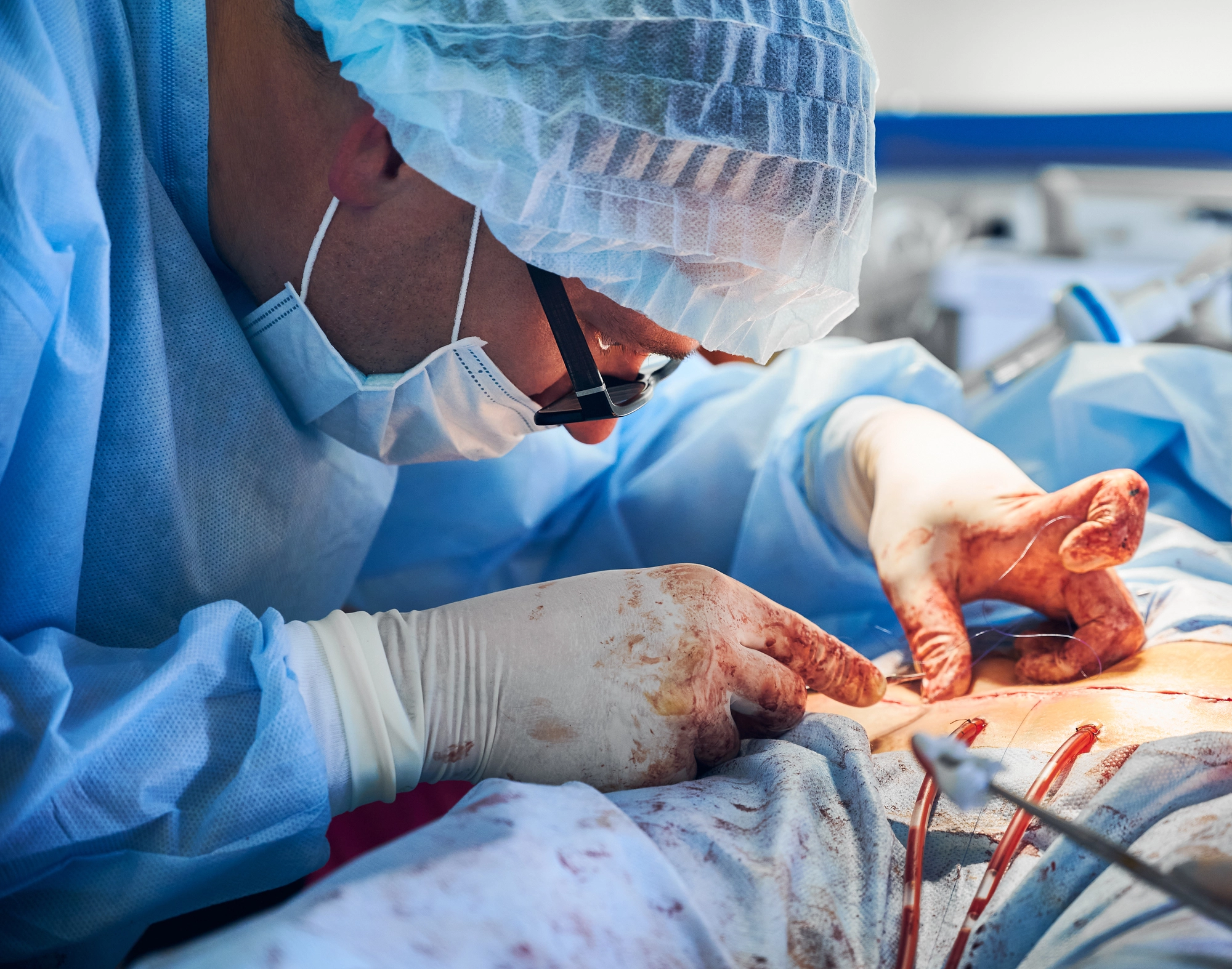 Reparación quirúrgica de hernia