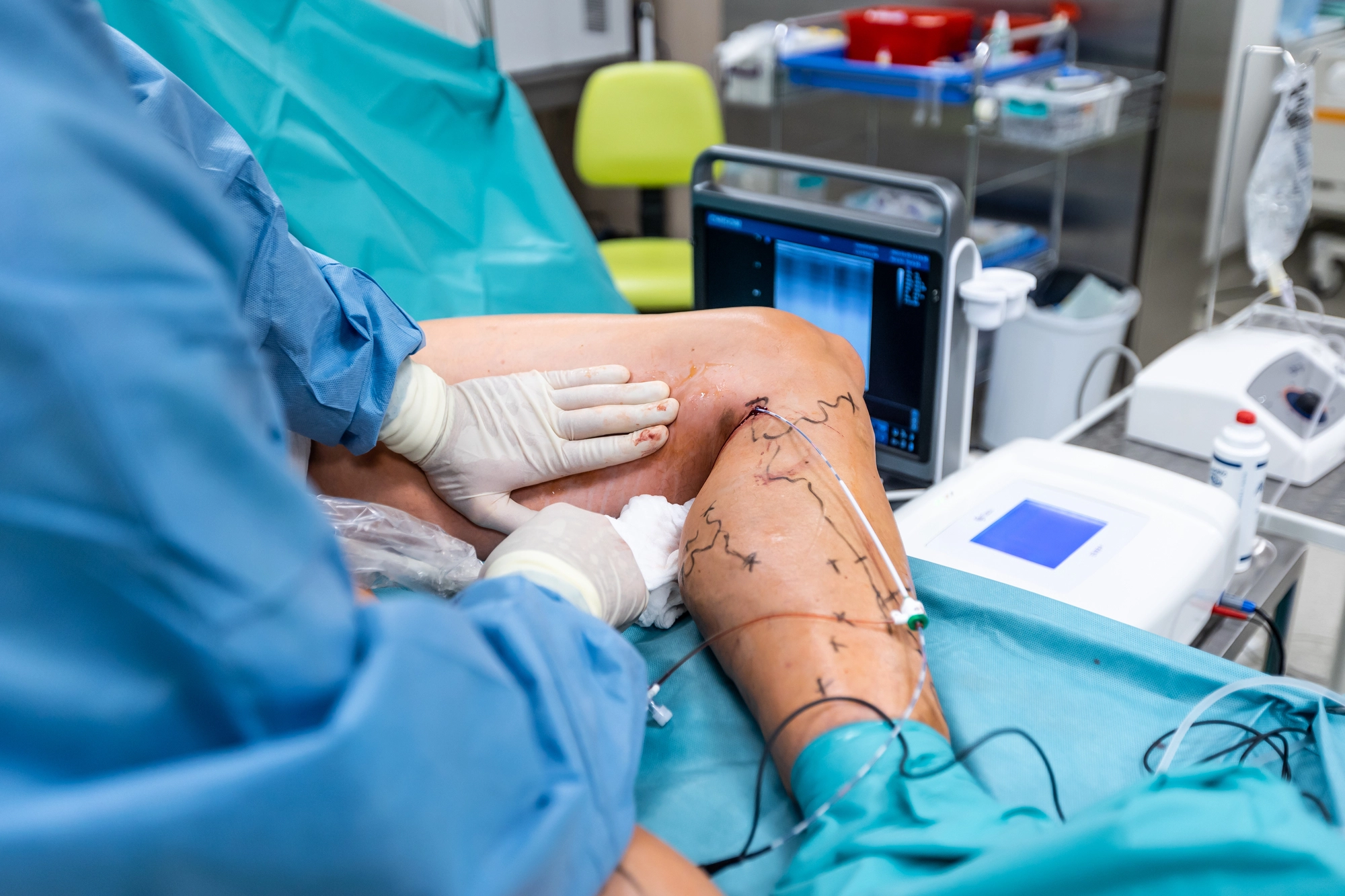 Beneficios cirugía vascular